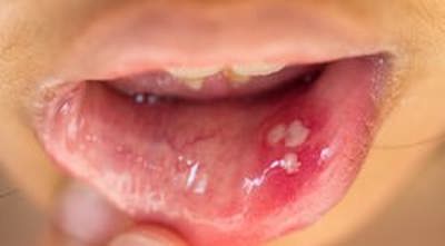 زگیل های ویروس hpv در داخل دهان مری و حلق