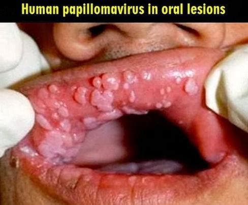 زگیل های ویروس اچ پی وی در داخل دهان و مری و حلق
